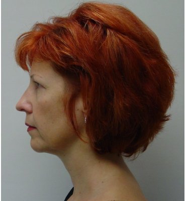 facelift and browlift